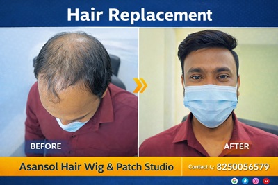 Men's Hair Replacement